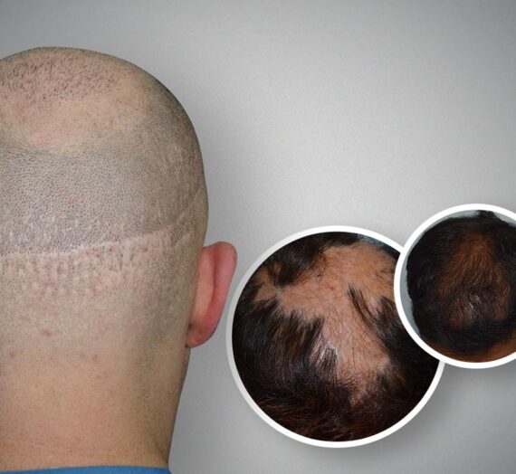 Reasons to try Scalp Micropigmentation