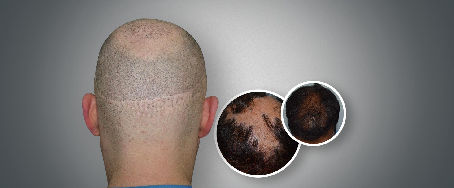 Reasons to try Scalp Micropigmentation