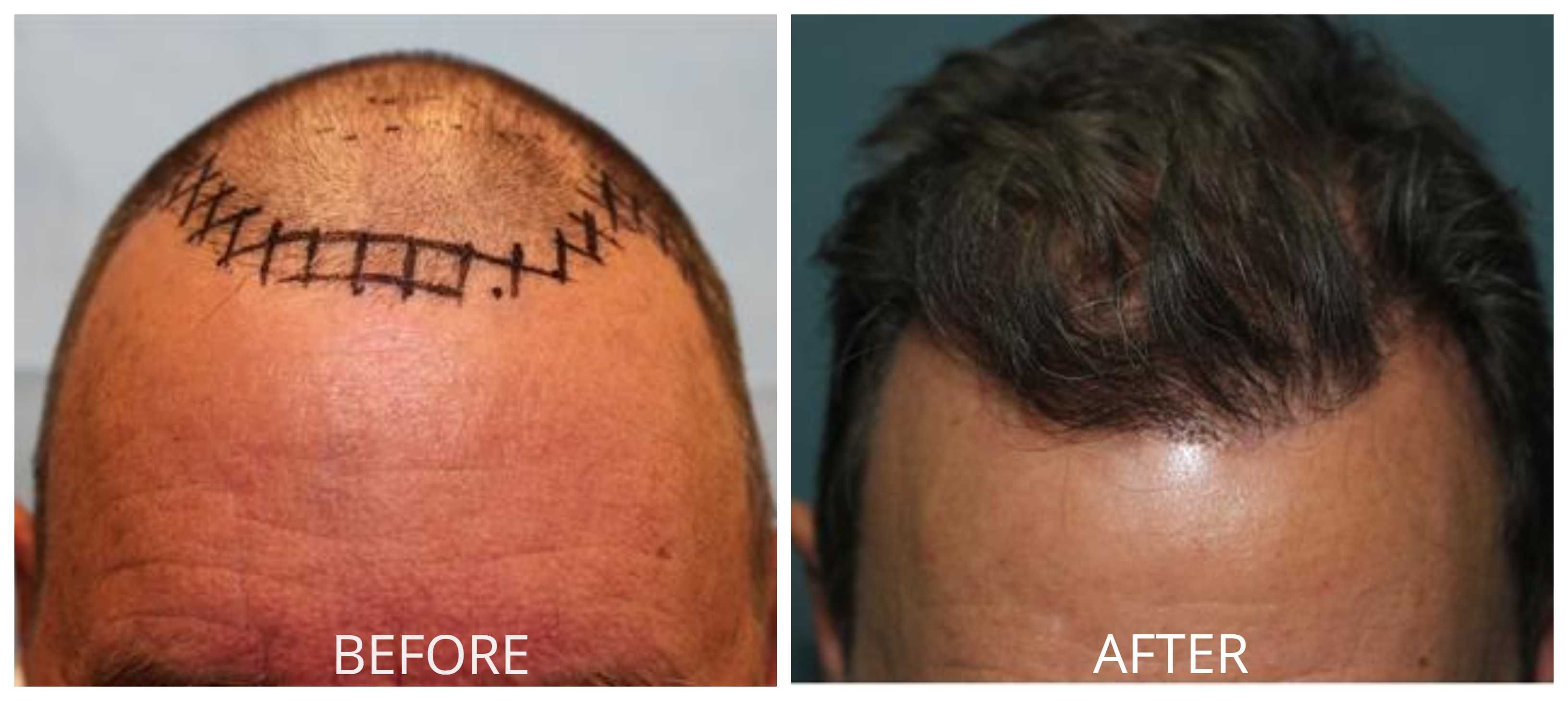 Best Orange County Hair Restoration Astonishes Customers