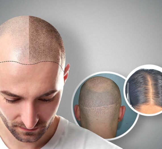 Detailed Information to Know about Scalp Micro Pigmentation