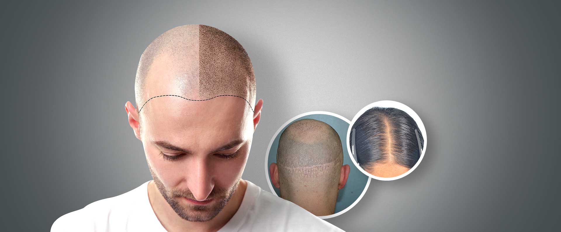 Detailed Information to Know about Scalp Micro Pigmentation