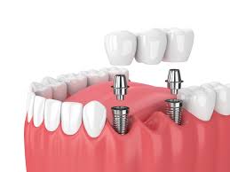 The Ultimate FAQ Guide to Restorative Dentistry and Oral Health